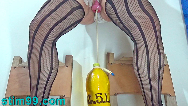 Cervix Prolapse with Bottles Hanging inside in Prolapsed Uterus