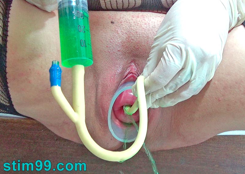 Stretching cervix by inflating a catheter and injecting fluid that expands the uterus