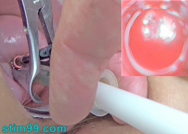 Semen Inside - Insemination with Semen in Cervix while Endoscope inside Uterus